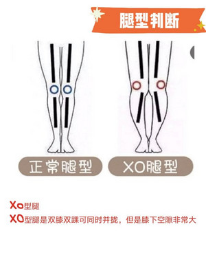 14脂包肌 XO型腿 瘦腿变直强攻略