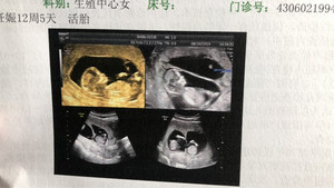 备孕两年多囊卵巢综合症促排龙凤胎（一）