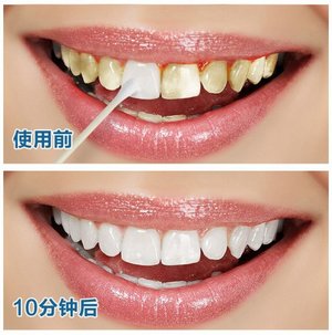洁牙素真的能美白牙齿吗？