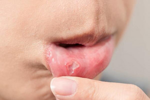 口腔白斑病是一种什么病？