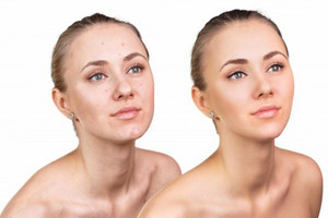 面部皮肤为什么会有油脂粒 注意脸上的清洁工作