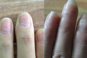 手指甲凹凸不平是怎么回事 这些原因一定要清楚