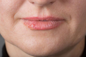 下嘴唇长泡是什么原因 五大作用原理快速告诉你