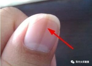 指甲上许多竖纹 可能是4种疾病的表示 别再傻傻忽视了