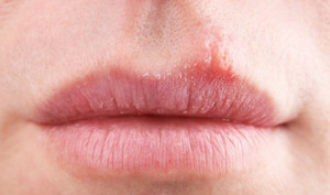 嘴唇长泡能够吃牛肉吗 四招治疗措施让你恢复粉嫩双唇