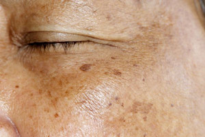 脸上长老年斑怎么办 教大家减缓皮肤衰老速度的好方法