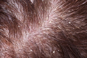 为什么头发里面长痘痘 是哪些原因引起的