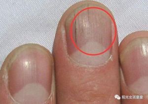 指甲上许多竖纹 可能是4种疾病的表示 别再傻傻忽视了