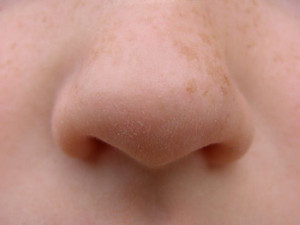 鼻子上长粉刺是什么原因 知道这些让你不再担忧它