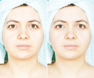鼻子上黑头螨虫图片分享 教大家如何有效恢复健康肌肤