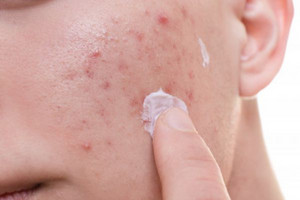 珍珠粉怎么用祛痘 推荐4种护肤方法